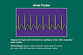 ECG in atrial flutter, illustration