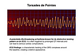 ECG displaying Torsades de pointes rhythm, illustration