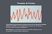 ECG displaying Torsades de pointes rhythm, illustration