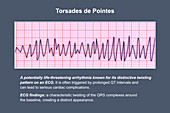 ECG displaying Torsades de pointes rhythm, illustration