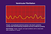 ECG in ventricular fibrillation, illustration