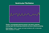 ECG in ventricular fibrillation, illustration