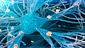 Amyloid plaques on nerve cells, illustration