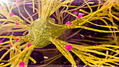 Amyloid plaques on nerve cells, illustration