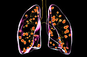 Lung histoplasmosis, illustration