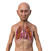 Lung histoplasmosis, illustration