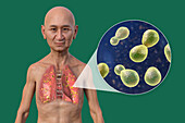 Lung histoplasmosis, illustration