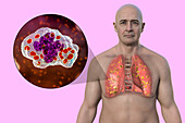 Lung histoplasmosis, illustration