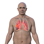 Man with lung mucormycosis lesion, illustration
