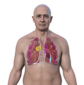 Primary lung tuberculosis, illustration