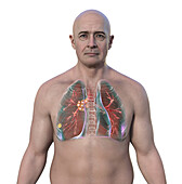 Primary lung tuberculosis with Ranke complex, illustration