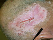Scalp ulcer due to itching