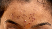 Acne vulgaris