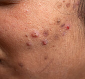 Acne vulgaris