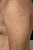 Acne vulgaris