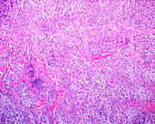 Pleomorphic adenoma in submaxillary gland, light micrograph