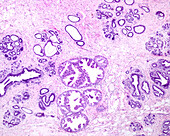 Breast apocrine metaplasia, light micrograph