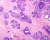 Breast adenosis, light micrograph