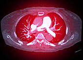 Pulmonary embolism, CT scan