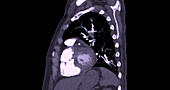 Pulmonary embolism, CT scan