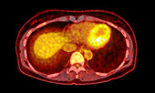 Normal abdomen, CT-PET scan