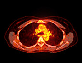 Healthy abdomen, CT-PET scan