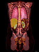 Healthy upper body, CT-PET scan