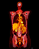 Healthy upper body, CT-PET scan