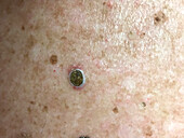 Dilated pore of Winer