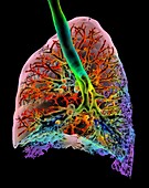 Interstitial lung disease, 3D CT scan