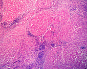 Cirrhosis, light micrograph