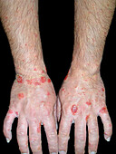 Dyshidrotic and nummular eczema