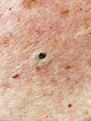 Dilated pore of Winer