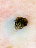 Dilated pore of Winer, dermoscopy