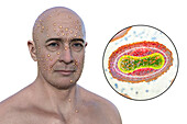 Man with rash from pox virus infection, illustration