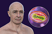 Man with rash from pox virus infection, illustration