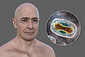 Man with rash from pox virus infection, illustration