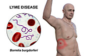 Lyme disease, illustration