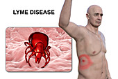 Lyme disease, illustration