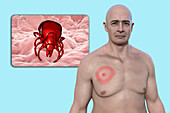 Lyme disease, illustration