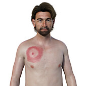 Man with erythema migrans from Lyme disease, illustration