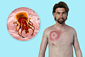 Man with erythema migrans from Lyme disease, illustration