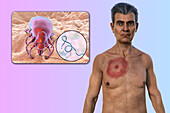 Man with erythema migrans from Lyme disease, illustration