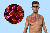 Man with erythema migrans from Lyme disease, illustration