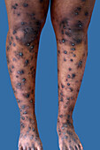 Prurigo lesions on a man's legs