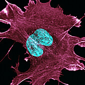 Ewing sarcoma cancer cell, confocal light micrograph