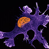 Ewing sarcoma cancer cell, confocal light micrograph