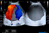 Abdominal aortic aneurism, ultrasound scan