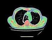 Azygos lobe, CT scan