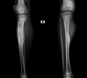 Bone cancer of the tibia, X-ray